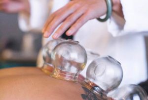 Acupuncture and cupping services Heather Fenwick